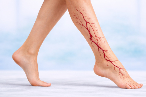 Варикоз без выпирающих вен: когда болезнь есть, но ее не видно
